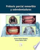 Prótesis parcial removible y sobredentaduras
